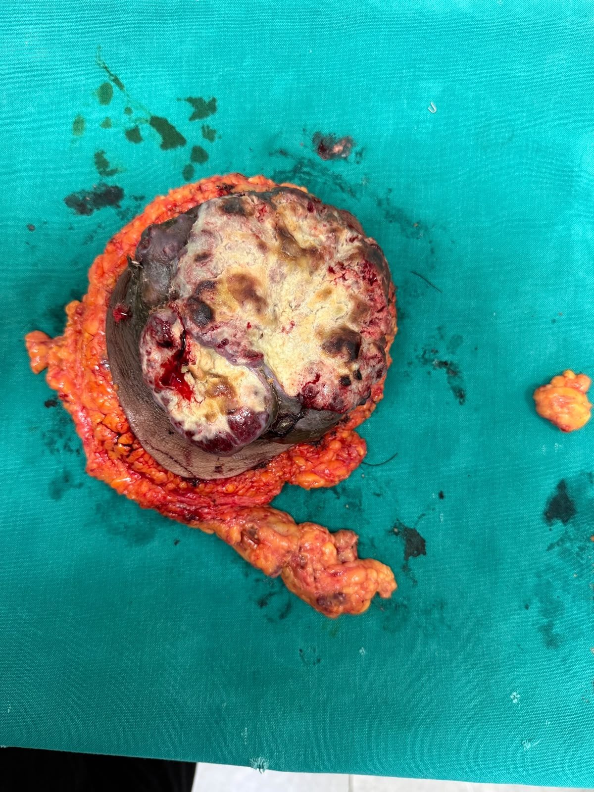 Excised mastectomy specimen with the tumour and overlying ulcerated skin