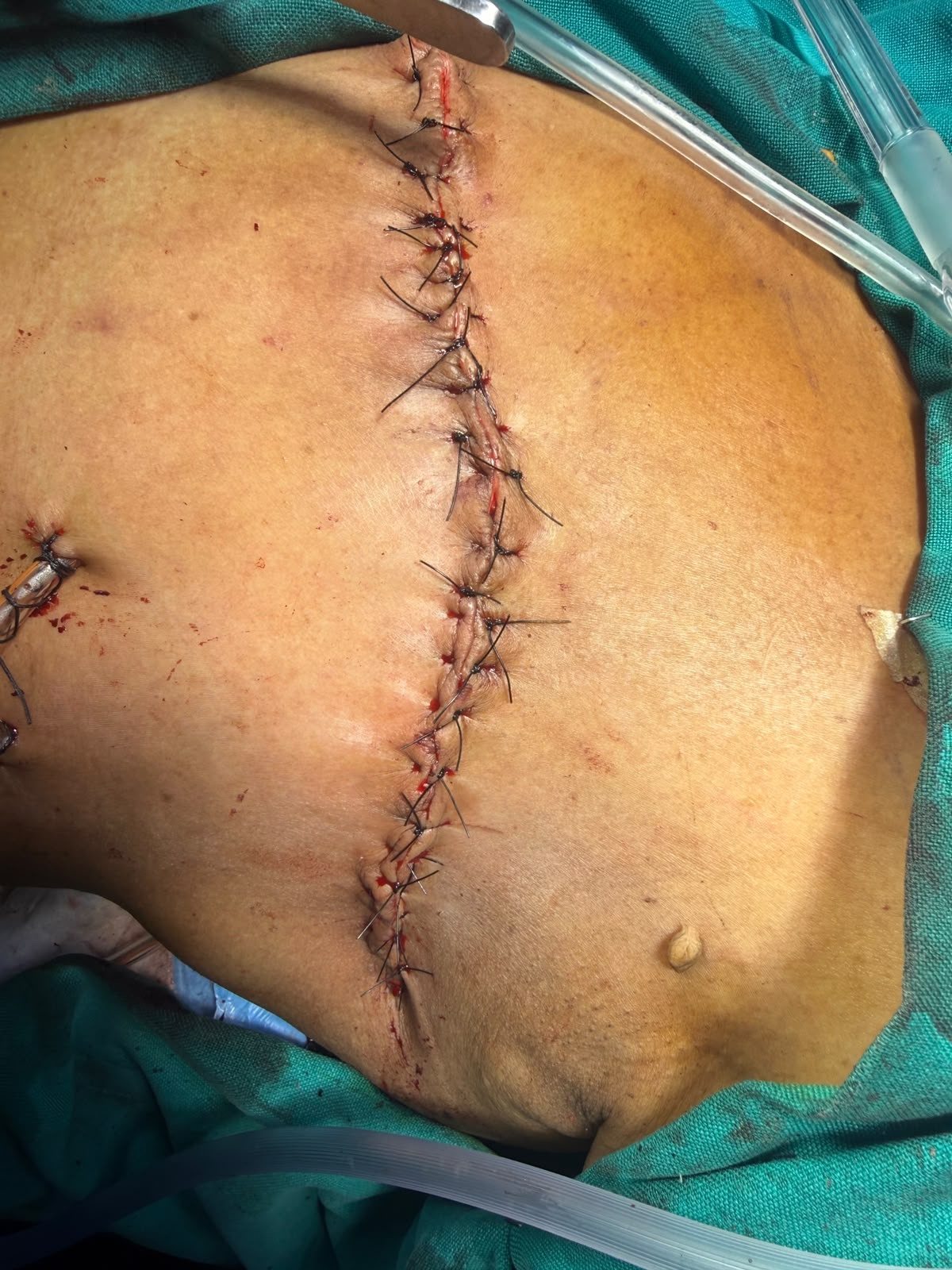 Closed surgical incision following modified radical mastectomy